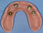 Figure 8  Final prosthesis with copings cured into denture base to provide 