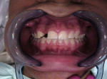 Figure 1  Congenitally missing lateral incisor to be restored with immediately loaded implant: preoperative digital image.
