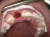 Figure 2  A preoperative retracted anterior view of the failing implant in the site of tooth No. 22.