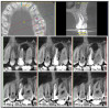 Figure 9  Orthodontic distraction osteogenesis to develop the implant site of tooth No. 23.