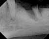 Figure 10  Radiograph of orthodontic distraction osteogenesis.