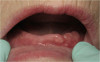 Figure 18   Implant placement with resulting facial dehiscence. Cortical perforations placed to promote angiogenesis.