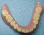 Figure 4  The patient’s existing denture was adapted.