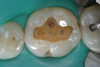 Figure 25  Postoperative view of definitive restorations teeth Nos. 7 to 9 and No. 23.