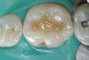 Figure 2f  Teeth Nos. 5 and 12 were converted to Nos. 6 and 11, and Nos. 6 and 11 were converted to Nos. 7 and 10. Nos. 4 and 13 were enlarged. Note stability and absence of orthodontic relapse. Before-and-after smiles.