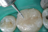 Figure 4a  Corticotomy SFOT. A 42-year-old male presented with a history of extraction orthodontic therapy (A). Incisors were too upright and had severe incisal wear. He was concerned about esthetics of the worn teeth and his insufficient lip support.