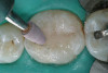 Figure 4b  Progress photo and panorex 9 months after corticotomies were performed on Nos. 6 through 11 (B and C). Previous extraction sites were reopened orthodontically to improve function and fill lip support. Incisal edges were restored provisionally with composite resin. Note that despite the creation of adequate spaces to replace missing teeth, there is inadequate room for placement of dental implants because of severe tipping of all the anterior teeth. Osteotomy SFOT may have been a better choice because it would have allowed needed alveoloskeletal correction (without excessive tipping) instead of the primarily dentoalveolar correction common in corticotomy SFOT. Restorative dentist: Brad Jones, DDS.