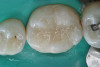 Figure 4c  Progress photo and panorex 9 months after corticotomies were performed on Nos. 6 through 11 (B and C). Previous extraction sites were reopened orthodontically to improve function and fill lip support. Incisal edges were restored provisionally with composite resin. Note that despite the creation of adequate spaces to replace missing teeth, there is inadequate room for placement of dental implants because of severe tipping of all the anterior teeth. Osteotomy SFOT may have been a better choice because it would have allowed needed alveoloskeletal correction (without excessive tipping) instead of the primarily dentoalveolar correction common in corticotomy SFOT. Restorative dentist: Brad Jones, DDS.