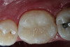 Figure 5a  A 22-year-old female presented, concerned about smile, overbite, and baby tooth. Facial views reveal excellent skeletal components with excessive gingival display and insufficient lip support. Anterior deep bite with extruded and retruded anterior dentition secondary to unstable relationship.