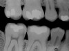 Figure 5b  A 22-year-old female presented, concerned about smile, overbite, and baby tooth. Facial views reveal excellent skeletal components with excessive gingival display and insufficient lip support (A and B). Anterior deep bite with extruded and retruded anterior dentition secondary to unstable relationship.