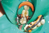 Figure 6b  A 50-year-old female concerned about appearance and bite. Jackscrew appliance was placed after 6 months of orthodontic alignment (A to C).