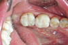 Figure 6c  A 50-year-old female concerned about appearance and bite. Jackscrew appliance was placed after 6 months of orthodontic alignment (A to C).