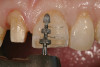 Figure 6h  Jackscrews were activated 0.5 mm/day after 5-day latency period. Note pure translation of segments without tipping. Result 8 months postsurgery. Tooth No. 12 was converted to a canine, and an implant was placed in regenerate bone. Note amount of alveoloskeletal correction and increase in volume of maxillary arch. Also note in Figure 6c and Figure 6c the amount of protraction of maxillary anterior segments while anchorage was maintained in posterior segment. Restorative dentist: Michael E. Carter, DDS.