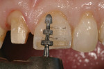 Figure 3  The depth-cutting burs are used in two planes to follow the labial morphology.
