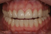 Figure 6i  Jackscrews were activated 0.5 mm/day after 5-day latency period. Note pure translation of segments without tipping. Result 8 months postsurgery. Tooth No. 12 was converted to a canine, and an implant was placed in regenerate bone. Note amount of alveoloskeletal correction and increase in volume of maxillary arch. Also note in Figure 6c and Figure 6c the amount of protraction of maxillary anterior segments while anchorage was maintained in posterior segment. Restorative dentist: Michael E. Carter, DDS.