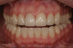 Figure 4  Postoperative view of a patient treated with a combination of veneers and crowns. They exhibit a consistent appearance of color, value, and translucency.