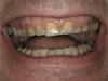 Figure 5  Re-entry 6 months postsurgery revealed a notable increase in the dimensions of the ridge.