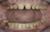 Figure 11  Blunt trauma to the patient’s face evulsed the right central incisor and damaged the facial plate.