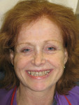 Figure 1  Preoperative photograph. The patient felt self-conscious about her smile and wanted them straighter and whiter. Note the asymmetry of her smile and facial structures, and note the way the maxillary arch canted downward toward the right.