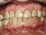 Figure 2  Preoperative retracted view. Note the reverse curve of Spee, and the asymmetry of the gingival lines. There was significant gingival recession on tooth No. 10, and tooth No. 5 was lingually positioned, making the tooth appear shorter.