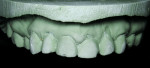 Figure 7  Diagnostic cast and wax-up: From the initial maxillary model, the laboratory was able to create the diagnostic esthetic wax-up.