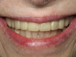 Figure 9  The patient wore her Snap-On Smile, which allowed her to try on a new, reversible smile before committing to veneers, for almost 2 years.