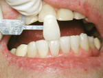 Figure 11  The patient’s lower teeth were isolated and whitened in three rounds of 20-minute sessions using a 25% hydrogen peroxide gel without a light source. She was then given a custom lower whitening tray to be worn at night for 2 weeks wit
