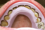 Figure 13  Enamel and gingival reduction: The incisal and buccal preparation guides (fashioned from the diagnostic wax-up) were used to verify proper reduction. Figure 14 shows the retracted view after gingival recontouring using a periodontal stint