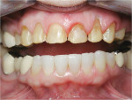 Figure 14  Enamel and gingival reduction: The incisal and buccal preparation guides (fashioned from the diagnostic wax-up) were used to verify proper reduction. Figure 14 shows the retracted view after gingival recontouring using a periodontal stint