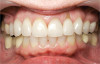 Figure 4a  Hopeless mandibular arch. Teeth Nos. 27, 26, 25, and 22 are present.