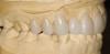 Figure 5c  After 3 months, prosthetic abutments were placed on implant Nos. 4, 5, 6, 9, 12, and 13, which then supported the provisional prosthesis. Teeth Nos. 7, 8, 10, and 14 were removed in the second round of implantations when additional implants were placed at site Nos. 8 and 10.
