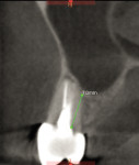 Fig 10. Radiograph of site.