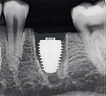 Fig 1. Ultra-wide-diameter implant (Southern Implants’ MAX) for immediate placement in molar extraction sockets.