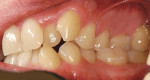 Figure 13  This mirror image of the patient’s right side shows the anterior and posterior crossbite, crowding, and loss of arch length due to a breaking of the dental arch form.