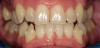 Figure 7i  The provisional prosthesis is replaced on teeth Nos. 5 through 13. Implant sites Nos. 5, 7, 10, 12, and 13 support the prosthesis.