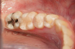 Figure 3  Teeth after gross placement and curing of composite material.