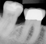 Figure 3  Posttreatment radiograph of tooth No. 31 showing the mesial bone fill.