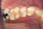 Figure 6  The final restorations in Clinical Example 1.