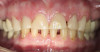 Figure 8   The intraoral photograph confirms and describes intensities of chroma that are not communicated on the stone model.