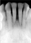 Figure 5  Pretreatment radiograph showing type IV periodontal disease and primary occlusal trauma.