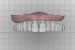 Fig 12. In the digital workflow, anterior and posterior teeth can be analyzed utilizing a reference grid for measuring facial surface of teeth to incisive papillae. The smile line, midline, incisal edge position, and buccal corridor are also analyzed with a 1-mm grid overlay.