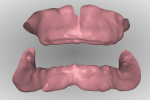 Fig 13. With a digital design workflow, the inter-arch ridge relationship can be analyzed from a facial/labial and posterior perspective while manipulating the size and position with a mouse.
