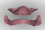 Fig 14. With a digital design workflow, the inter-arch ridge relationship can be analyzed from a facial/labial and posterior perspective while manipulating the size and position with a mouse.