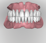 Fig 15. After the ridge is analyzed denture teeth are digitally arranged according to reference record as in Figure 10. With a digital workflow all the anterior teeth are set at once followed by all posteriors on the arch. Tooth arrangement and occlusion can be viewed in all possible perspectives in relation to residual ridges.