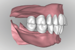 Fig 16. After the ridge is analyzed denture teeth are digitally arranged according to reference record as in Figure 10. With a digital workflow all the anterior teeth are set at once followed by all posteriors on the arch. Tooth arrangement and occlusion can be viewed in all possible perspectives in relation to residual ridges.