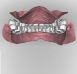 Fig 17. After the ridge is analyzed denture teeth are digitally arranged according to reference record as in Figure 10. With a digital workflow all the anterior teeth are set at once followed by all posteriors on the arch. Tooth arrangement and occlusion can be viewed in all possible perspectives in relation to residual ridges.