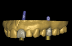 Fig 7. An STL model obtained from an intraoral scan shows digital teeth placed to ensure the implants are virtually planned in an ideal restorative position.