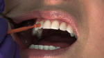 Figure 2  Clinical application of the product. Vanish white varnish is easy to apply; the product is simply swept on the tooth surface in one thin coat, after which it covers and adheres to the teeth.