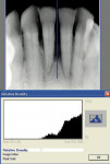 Figure 7  Preoperative radiographic density of teeth Nos. 24 and 25.
