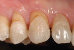 Figure  3  CLINICAL EXAMPLES Root decay and moderate gingival recession was present along the premolar and cuspid teeth.